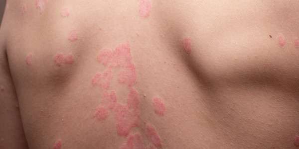 August - Psoriasis Awareness Month