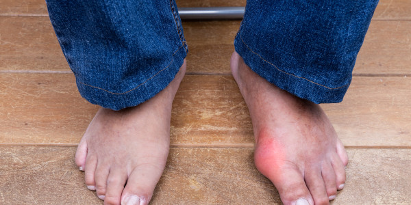 Gout – The Disease of Kings